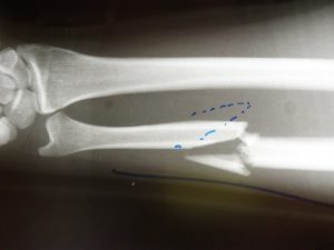 comminuted ulna fracture